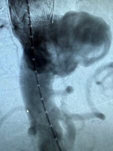 Aneurysma